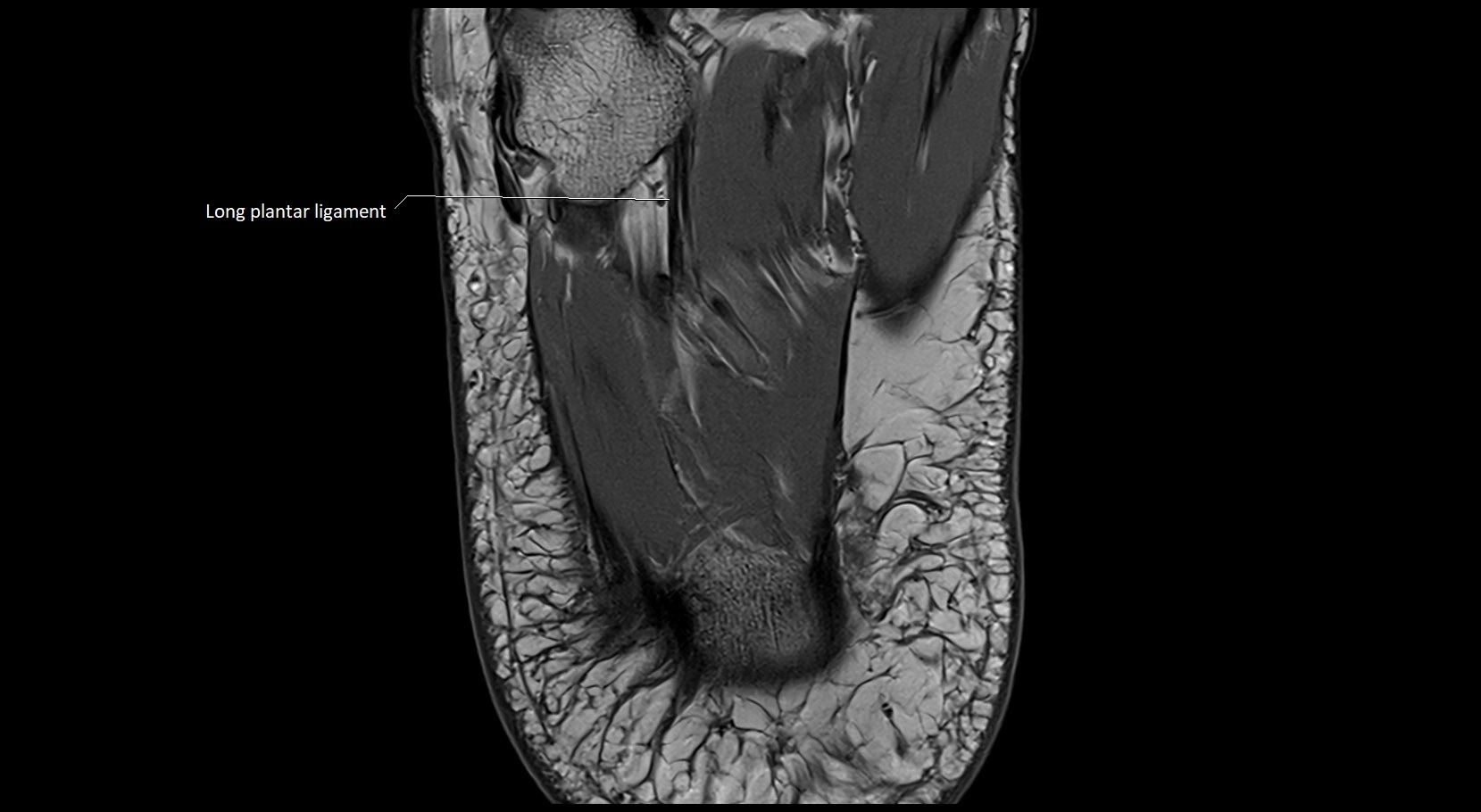 MRI ankle ligaments anatomy axial 3T image 28.webp
